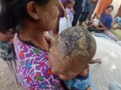 သံတွဲနဲ့ ကျိန္တလီမြို့က စစ်ရှောင်ပြည်သူ ၄၀၀ ကျော် အရေပြားရောဂါဖြစ်နေ